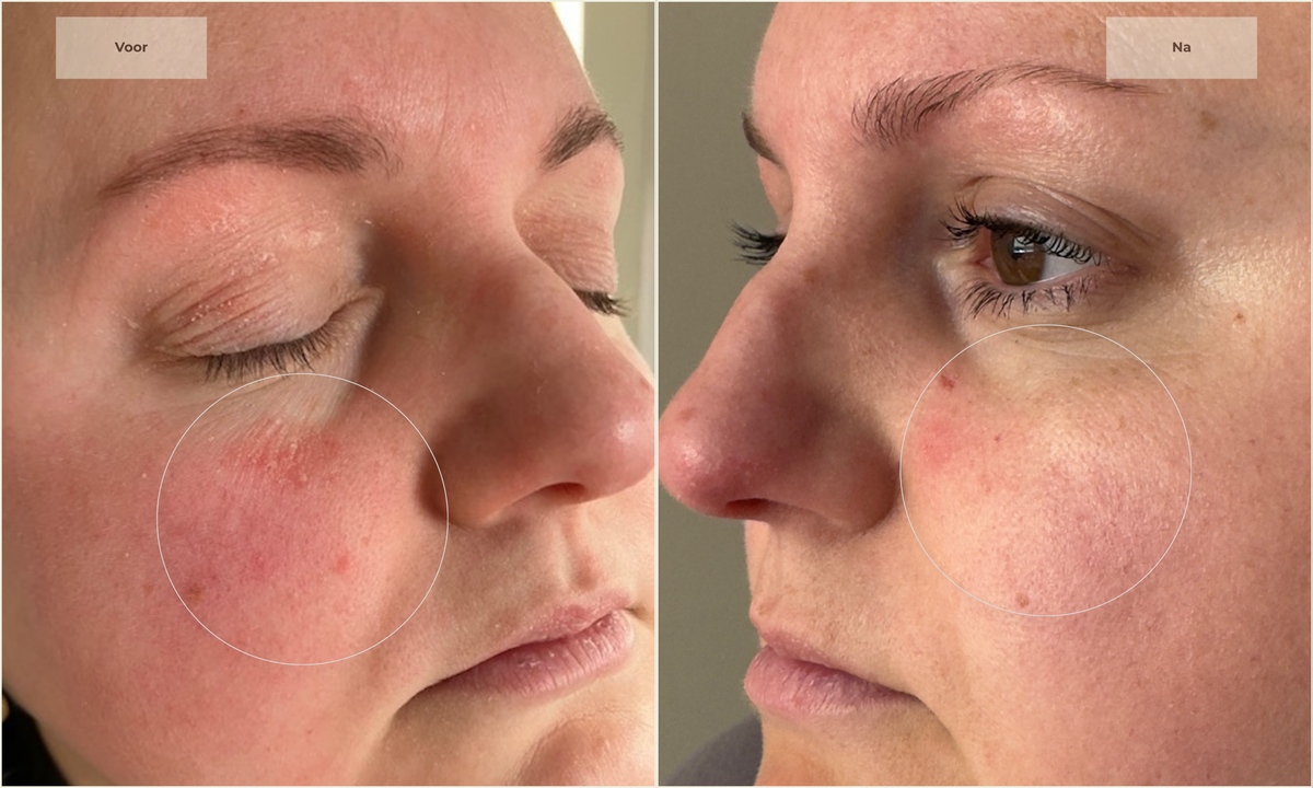 vrouw gebruikt rood licht LED-masker thuis